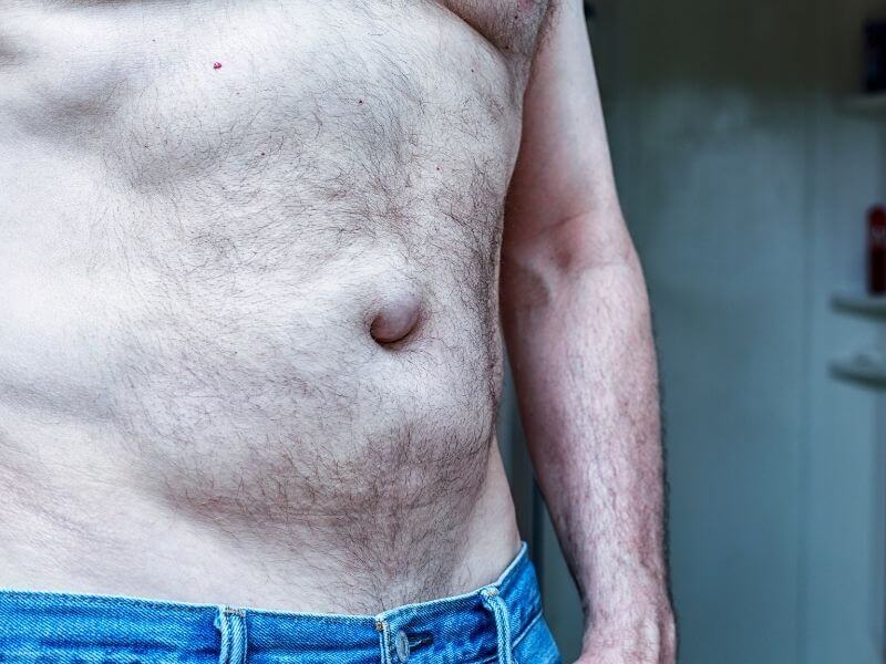 Hernia-Umbilical
