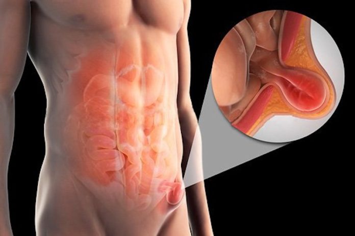 hernia-lingual-696x464