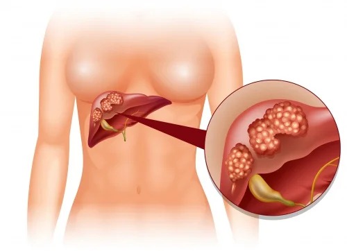 Quistes-hepaticos-1