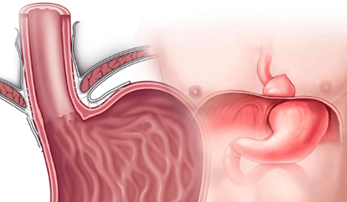 hernia-hiato